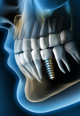 Sie sehen ein Implantat, um eine mögliche Implantatslösung bei Ihrem Zahnarzt zu veranschaulichen